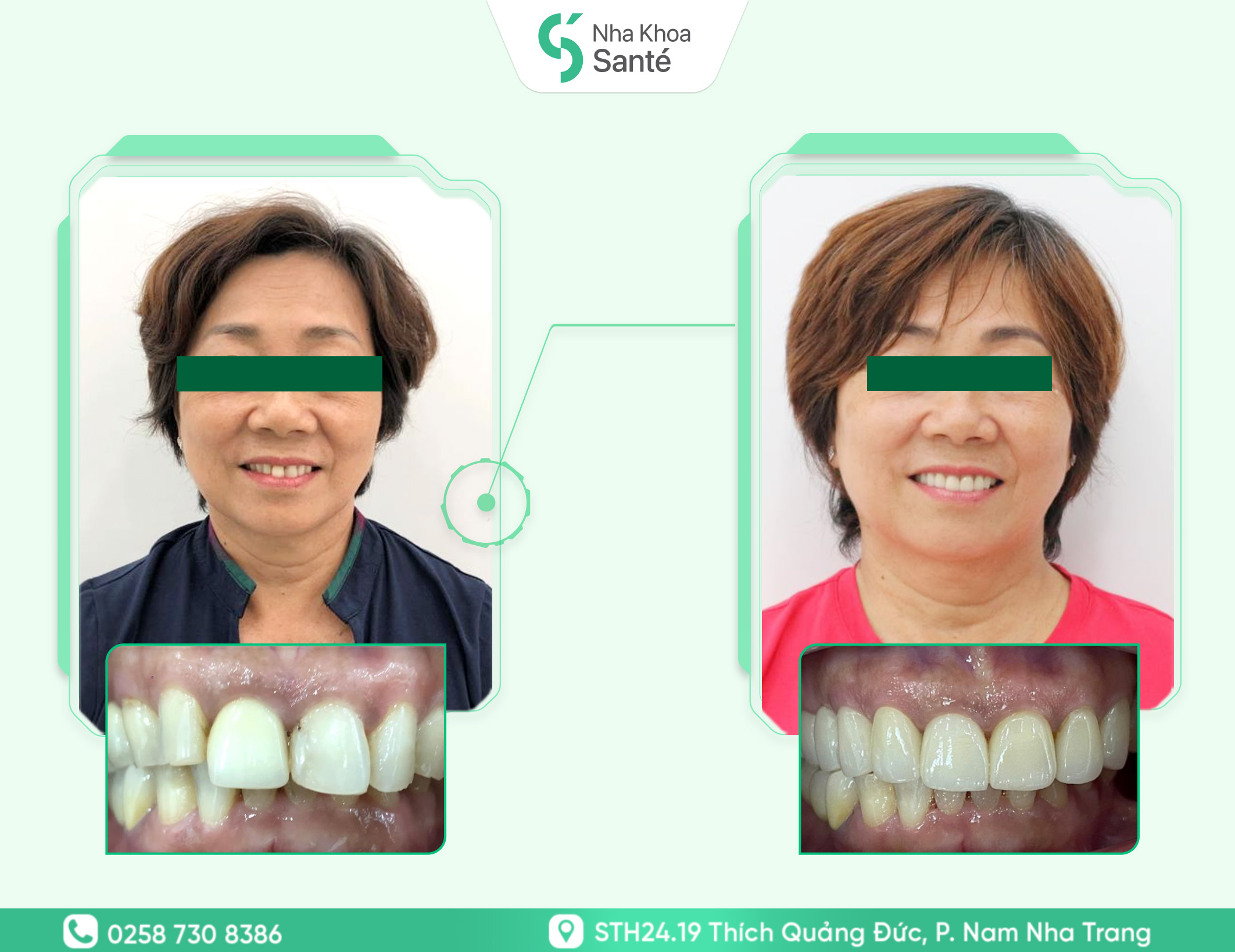 Case-dan-veneer ( 1 )