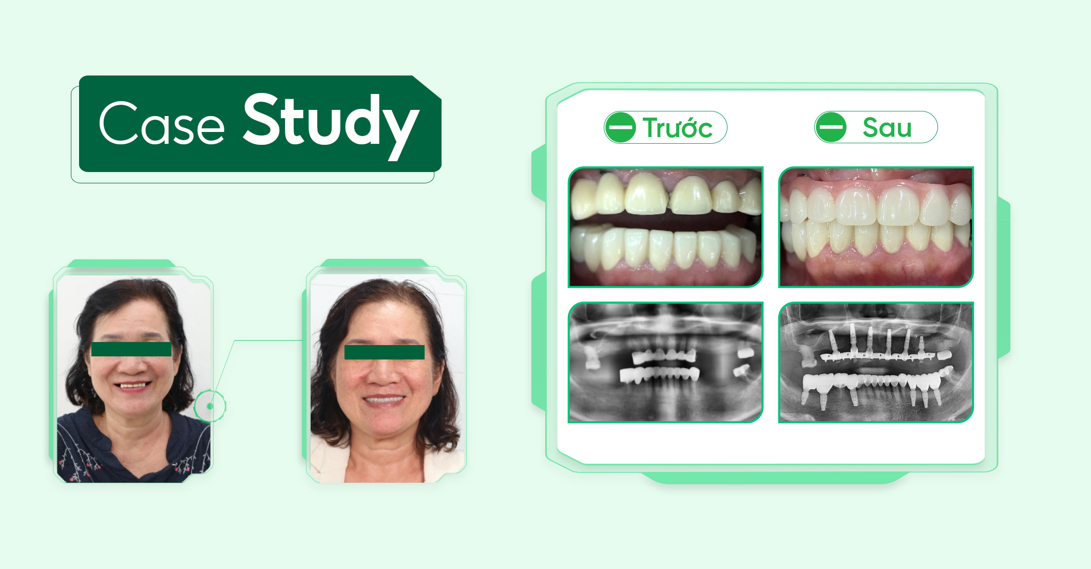 Case-implant-all-on (1)