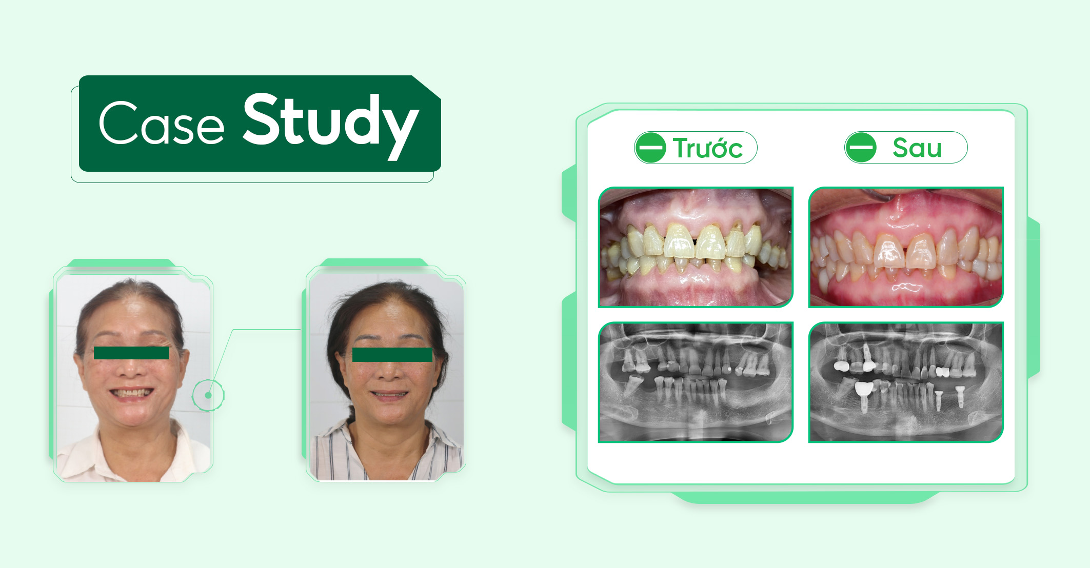 Case-implant-vai-rang (1)