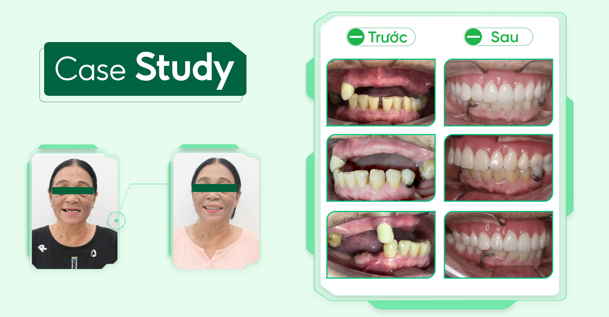 Case-phuc-hinh-thao-lap (1)