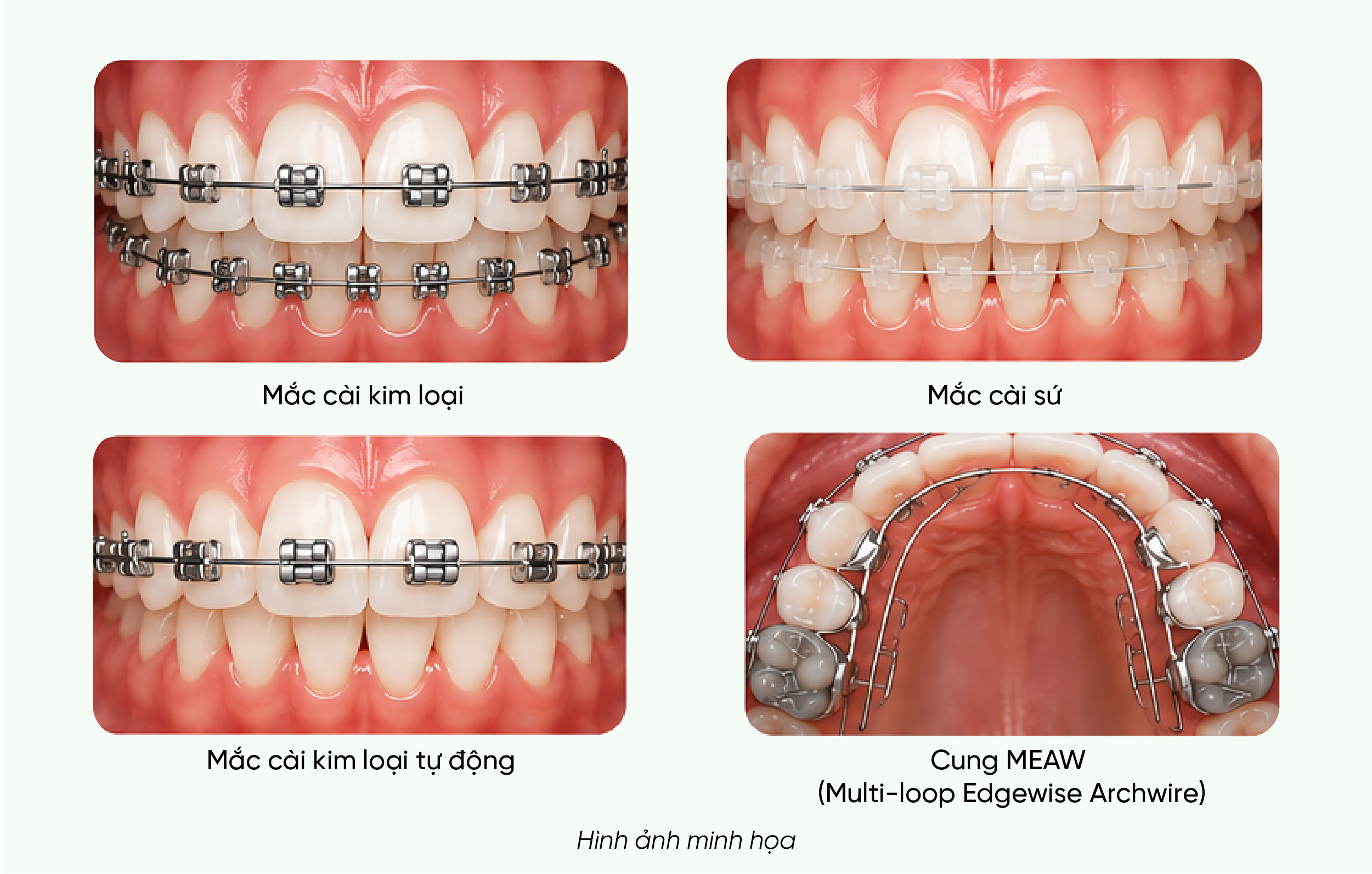mac-cai-kim-loai